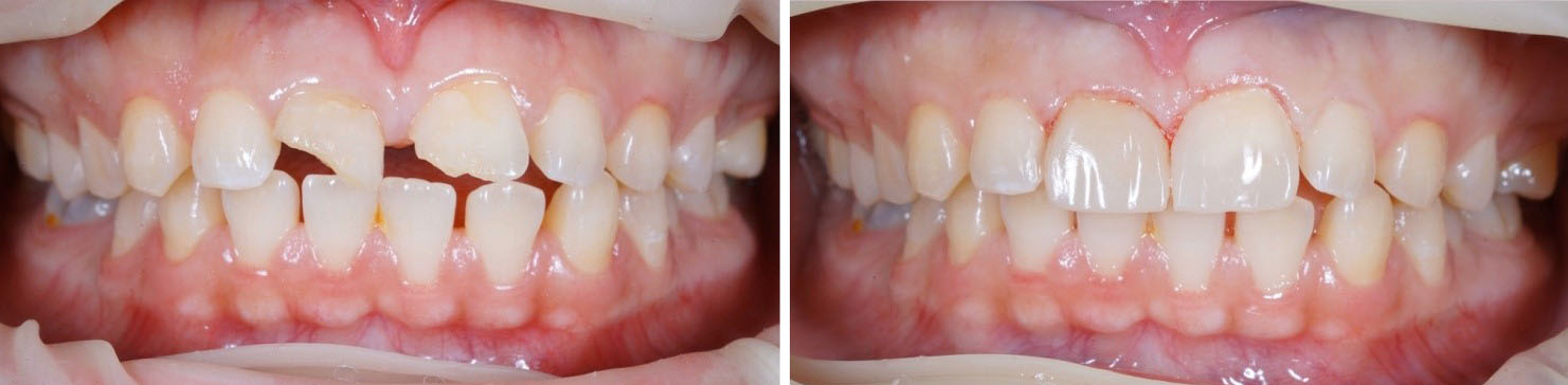 composite filling before and after