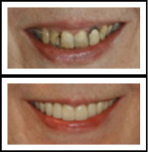 teeth fully restored