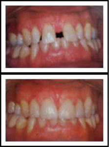 missing teeth fixed - before and after