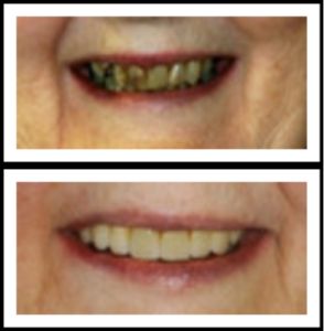 before and after teeth restoration